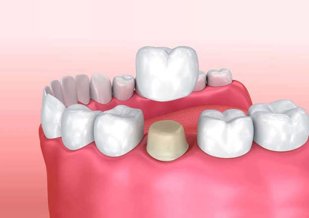dental crowns yorba linda