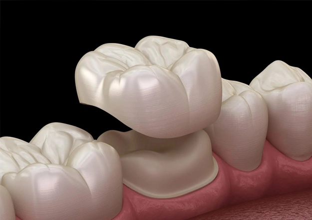 porcelain crowns (caps) yorba linda